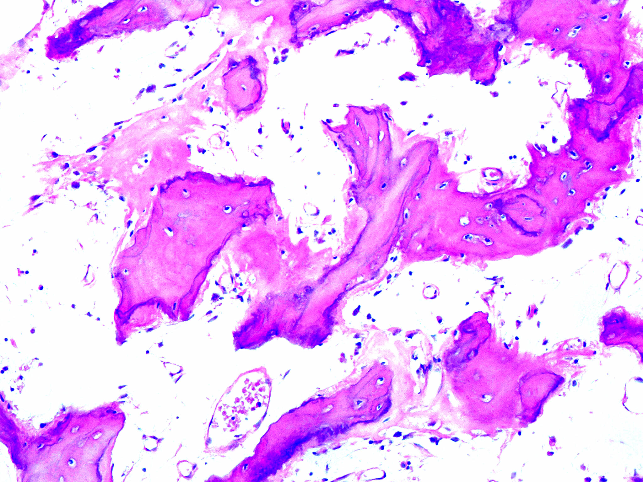 Pathology Outlines Paget disease